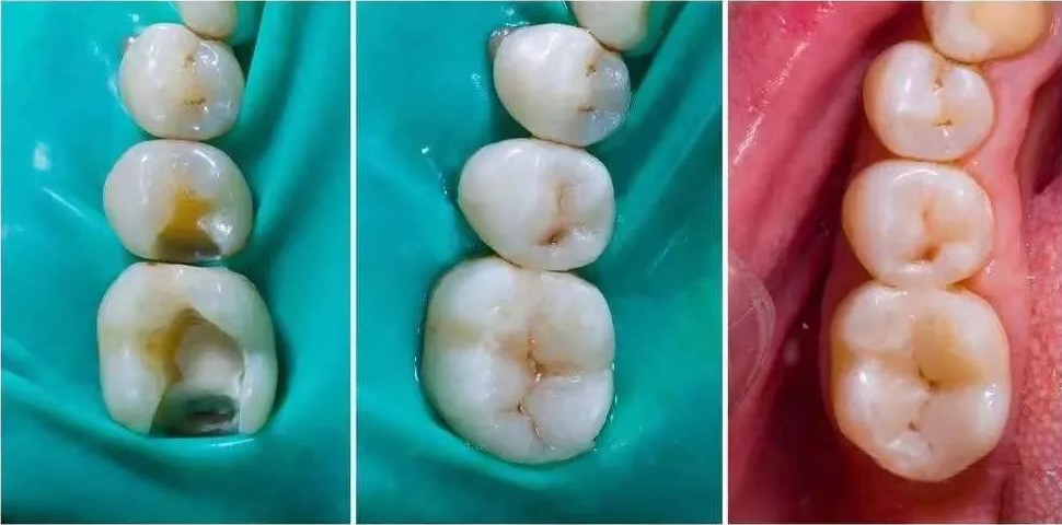 浅龋、中龋补牙就可以了，深龋要怎么办？