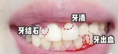 易患牙周病的人群! 易患牙周病的人群!