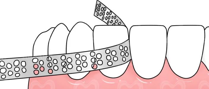 邻面去釉常见的问题! 邻面去釉常见的问题!