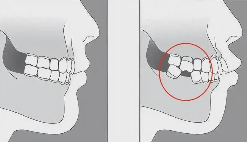 缺牙久了,还有必要种植牙吗? 缺牙久了,还有必要种植牙吗?