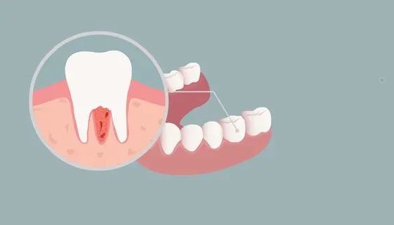 缺牙久了,还有必要种植牙吗? 缺牙久了,还有必要种植牙吗?