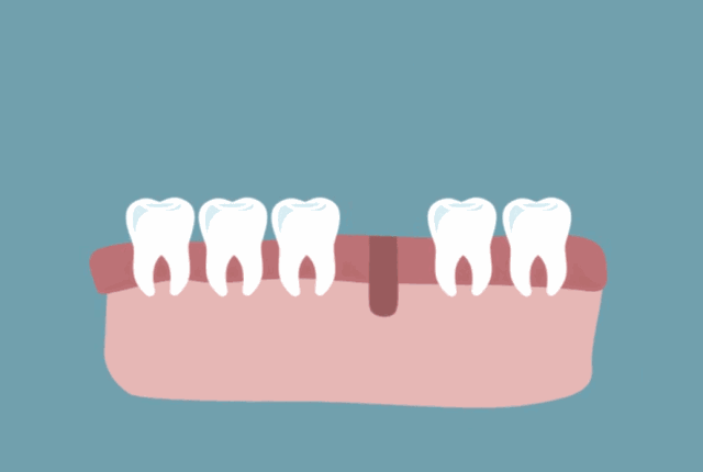 缺牙久了,还有必要种植牙吗? 缺牙久了,还有必要种植牙吗?