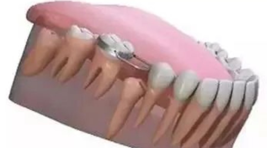 乳牙早失不重视,孩子的好牙就毁了! 乳牙早失不重视,孩子的好牙就毁了!