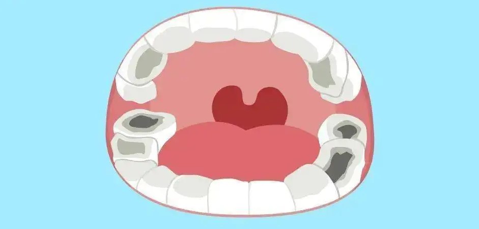 乳牙换恒牙前后应注意啥？