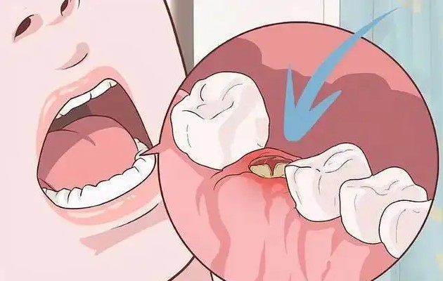 医生,拔牙后发烧是咋回事? 医生,拔牙后发烧是咋回事?