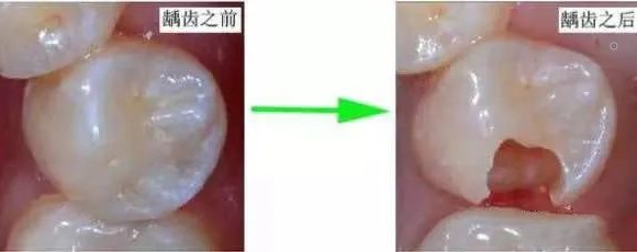 塞牙也是一种病？分享解决方法！