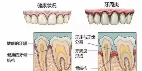 塞牙也是一种病？分享解决方法！