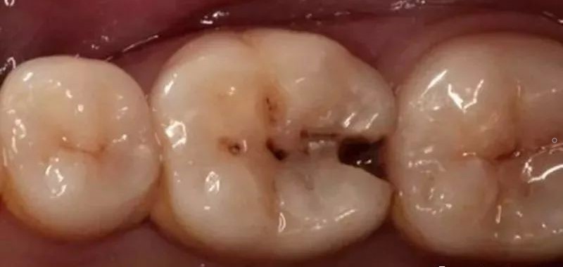 吃饭总塞牙,牙齿矫正能解决吗?—义乌傅氏口腔 吃饭总塞牙,牙齿矫正能解决吗?—义乌傅氏口腔