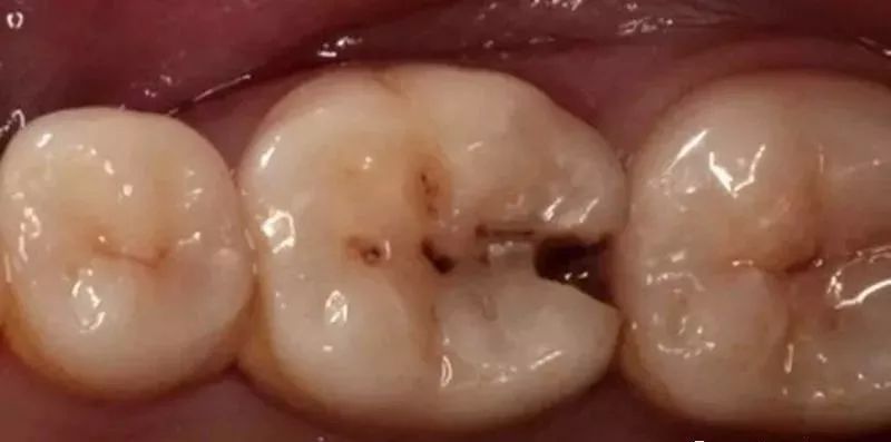 吃饭时总塞牙，问题出在那里？—义乌傅氏口腔