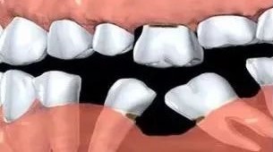 吃饭总塞牙,牙齿矫正能解决吗?—义乌傅氏口腔 吃饭总塞牙,牙齿矫正能解决吗?—义乌傅氏口腔