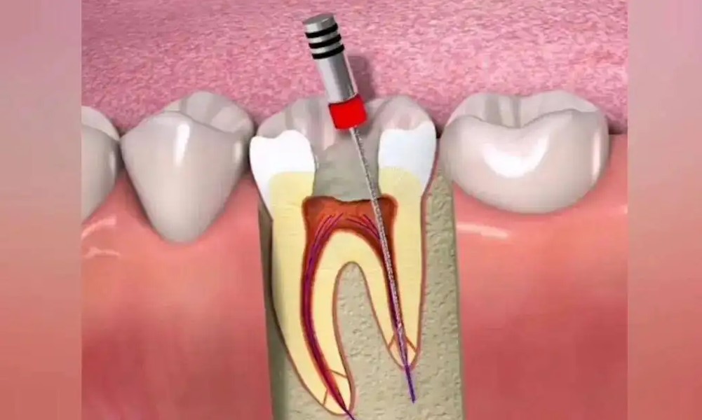 根管充填失败的原因！