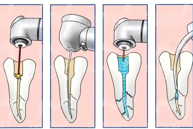 根管充填失败的原因！