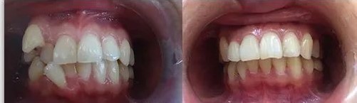 牙齿矫正为何要两年时间能缩短吗? 牙齿矫正为何要两年时间能缩短吗?