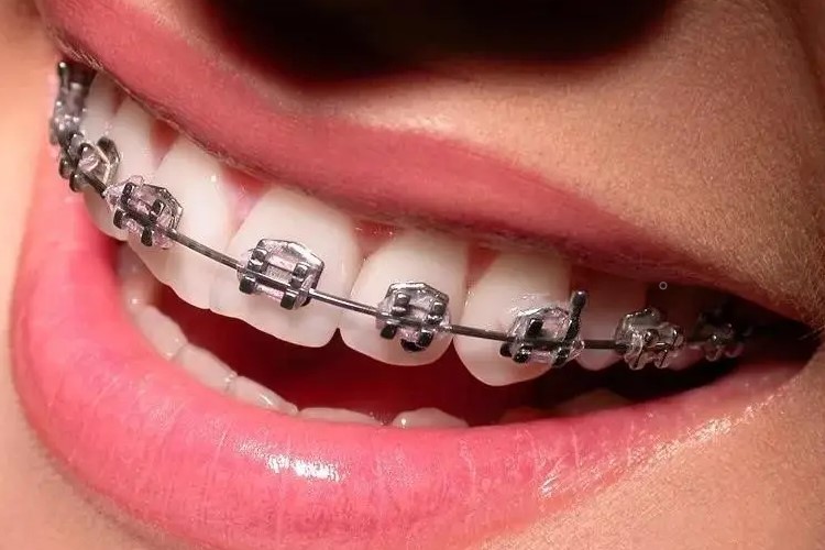 牙齿矫正为何要两年时间能缩短吗? 牙齿矫正为何要两年时间能缩短吗?