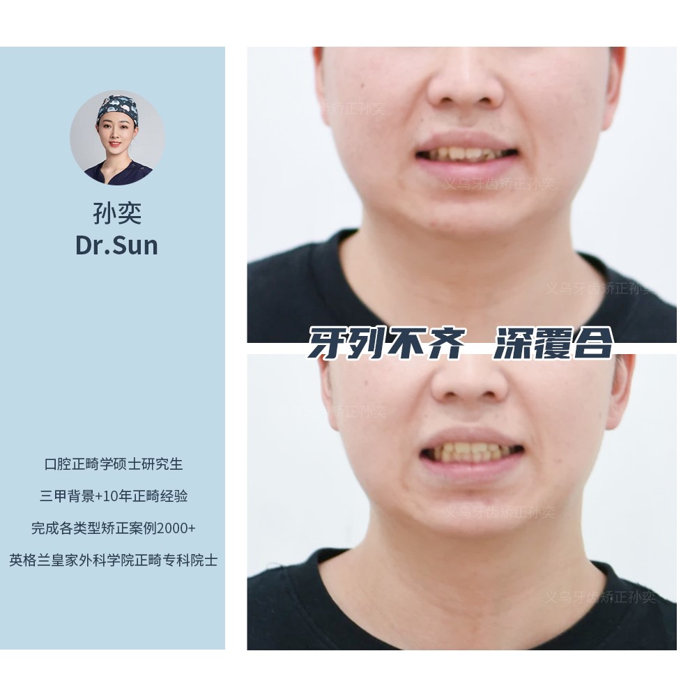 义乌傅氏口腔牙列不齐、深覆合矫正案例分享！