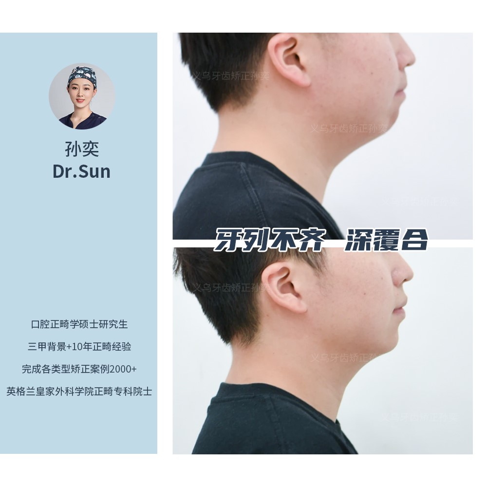 义乌傅氏口腔牙列不齐、深覆合矫正案例分享！