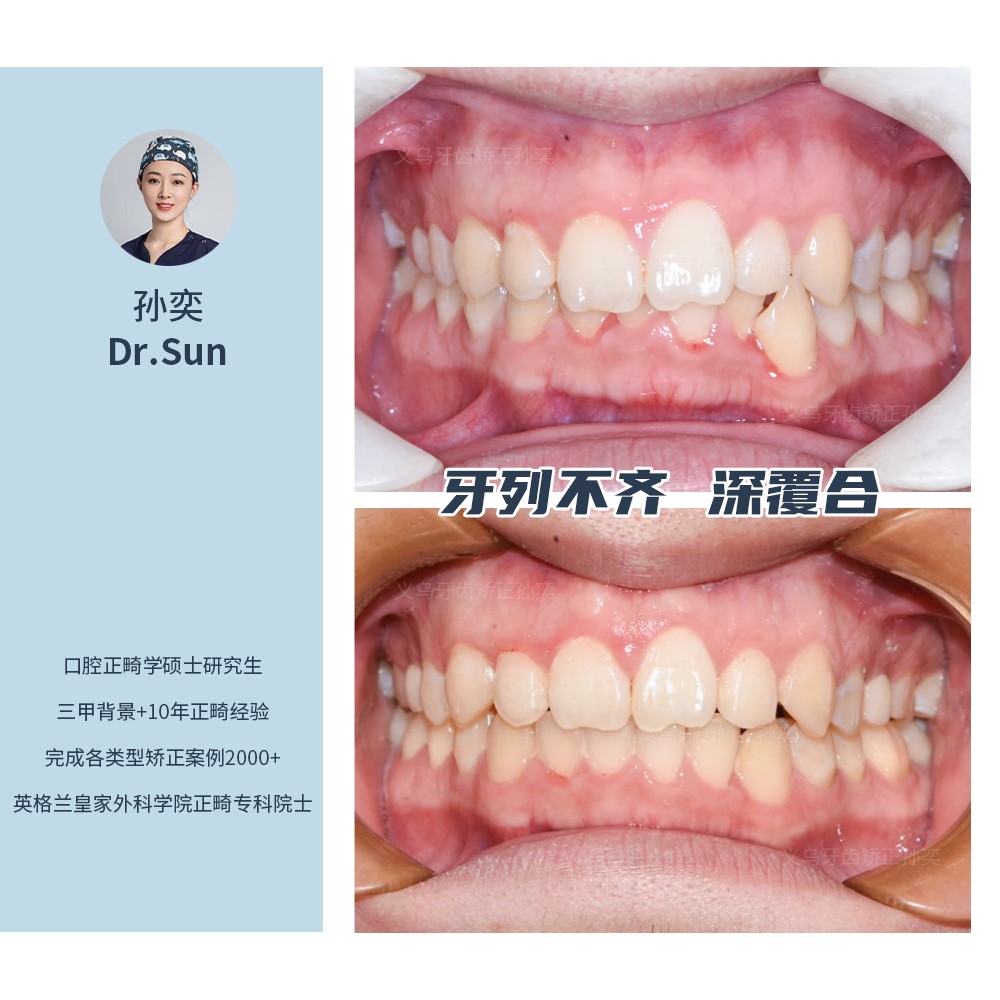 义乌傅氏口腔牙列不齐、深覆合矫正案例分享！