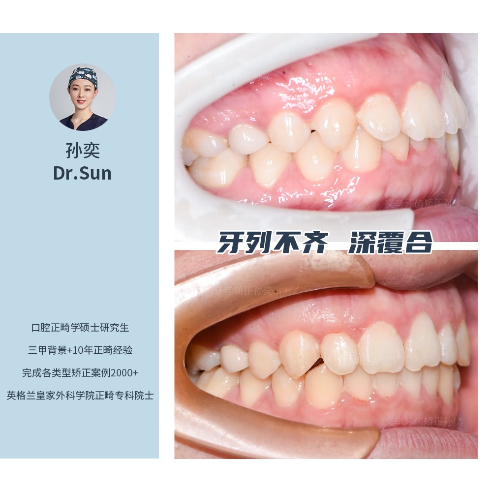 义乌傅氏口腔牙列不齐、深覆合矫正案例分享！