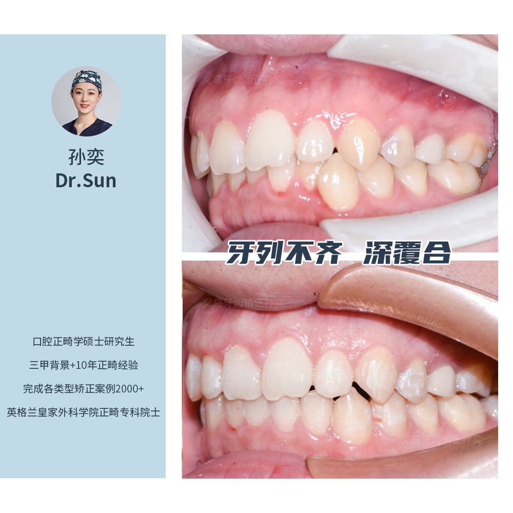义乌傅氏口腔牙列不齐、深覆合矫正案例分享！
