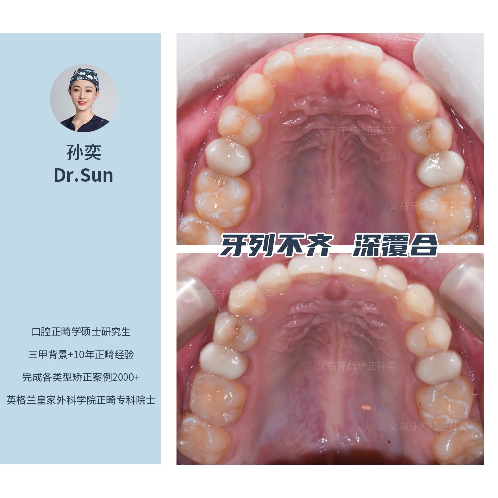义乌傅氏口腔牙列不齐、深覆合矫正案例分享！
