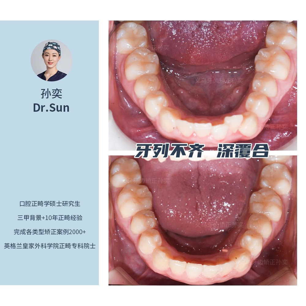 义乌傅氏口腔牙列不齐、深覆合矫正案例分享！