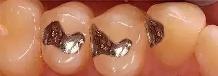 为何刚补过的牙还会酸痛? 为何刚补过的牙还会酸痛?