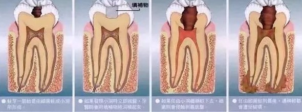 为何刚补过的牙还会酸痛? 为何刚补过的牙还会酸痛?