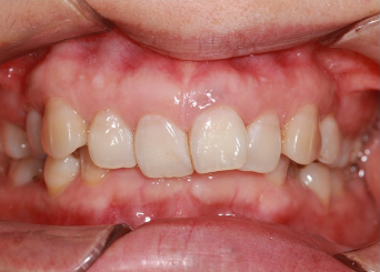 深覆合还有救吗？—义乌傅氏口腔