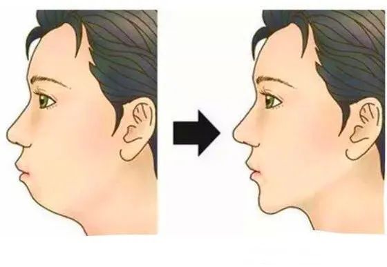 深覆合还有救吗？—义乌傅氏口腔