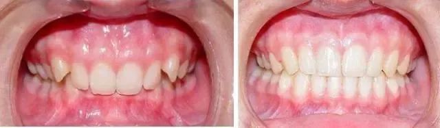 深覆合还有救吗？—义乌傅氏口腔