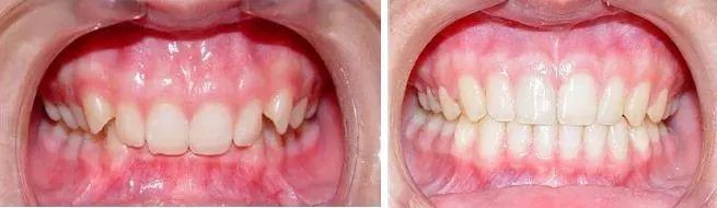 牙齿深覆合不进行矫正会有何危害呢?—义乌傅氏口腔 牙齿深覆合不进行矫正会有何危害呢?—义乌傅氏口腔