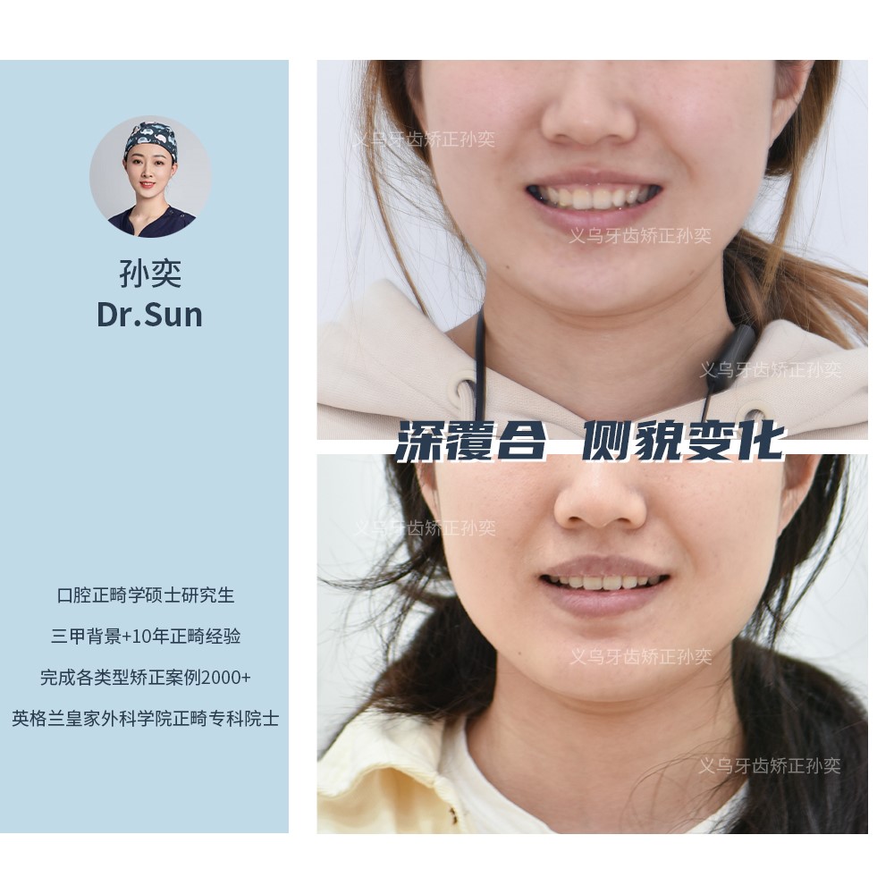 义乌傅氏口腔深覆合侧貌变化矫正案例分享！