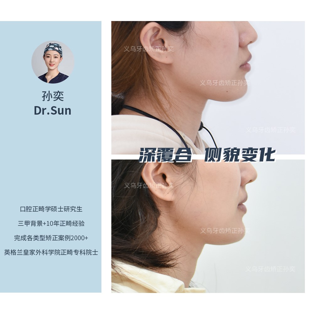 义乌傅氏口腔深覆合侧貌变化矫正案例分享！