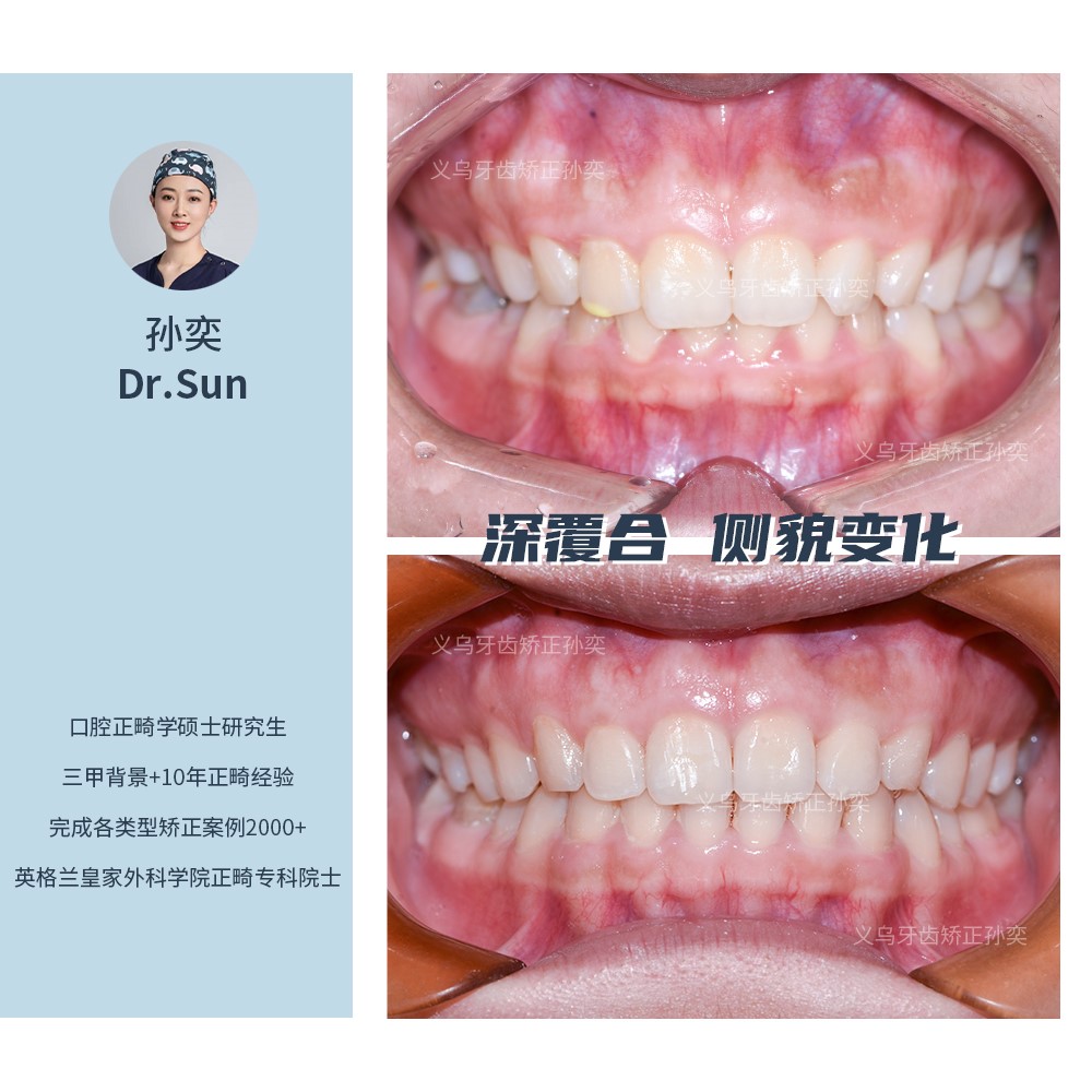 义乌傅氏口腔深覆合侧貌变化矫正案例分享！