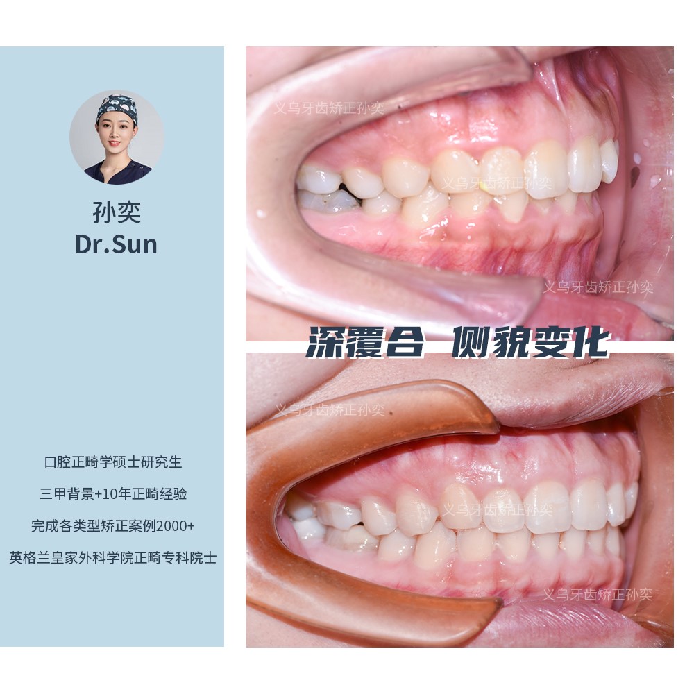 义乌傅氏口腔深覆合侧貌变化矫正案例分享！