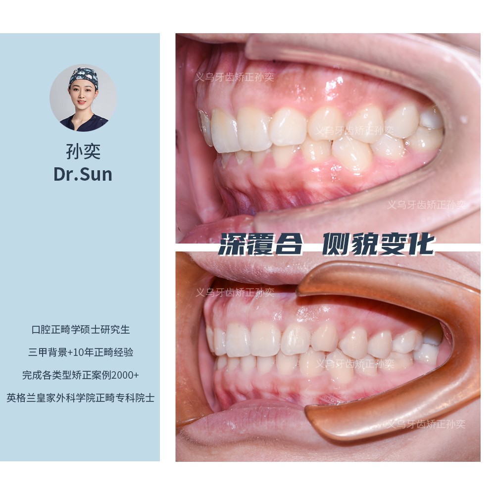 义乌傅氏口腔深覆合侧貌变化矫正案例分享！
