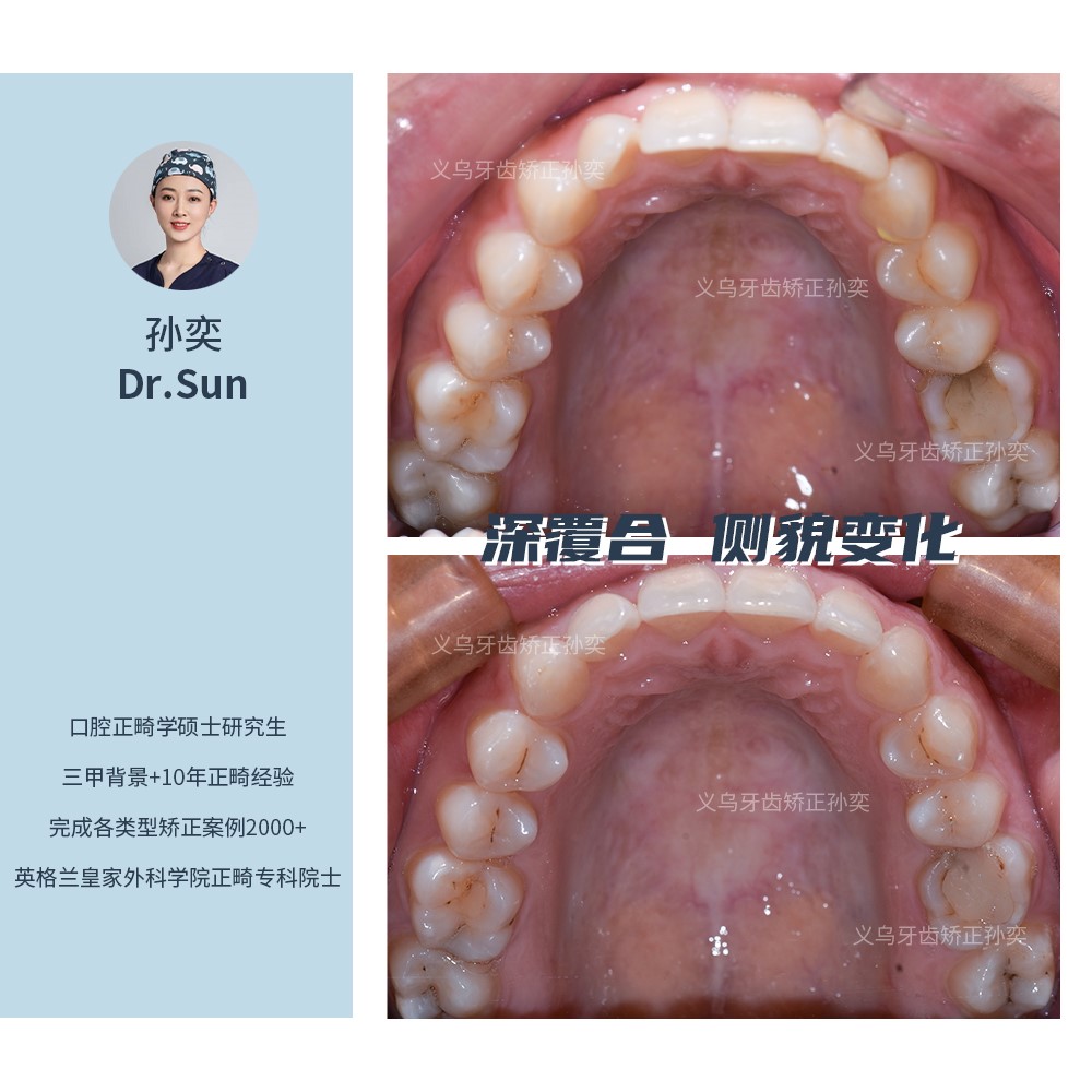 义乌傅氏口腔深覆合侧貌变化矫正案例分享！