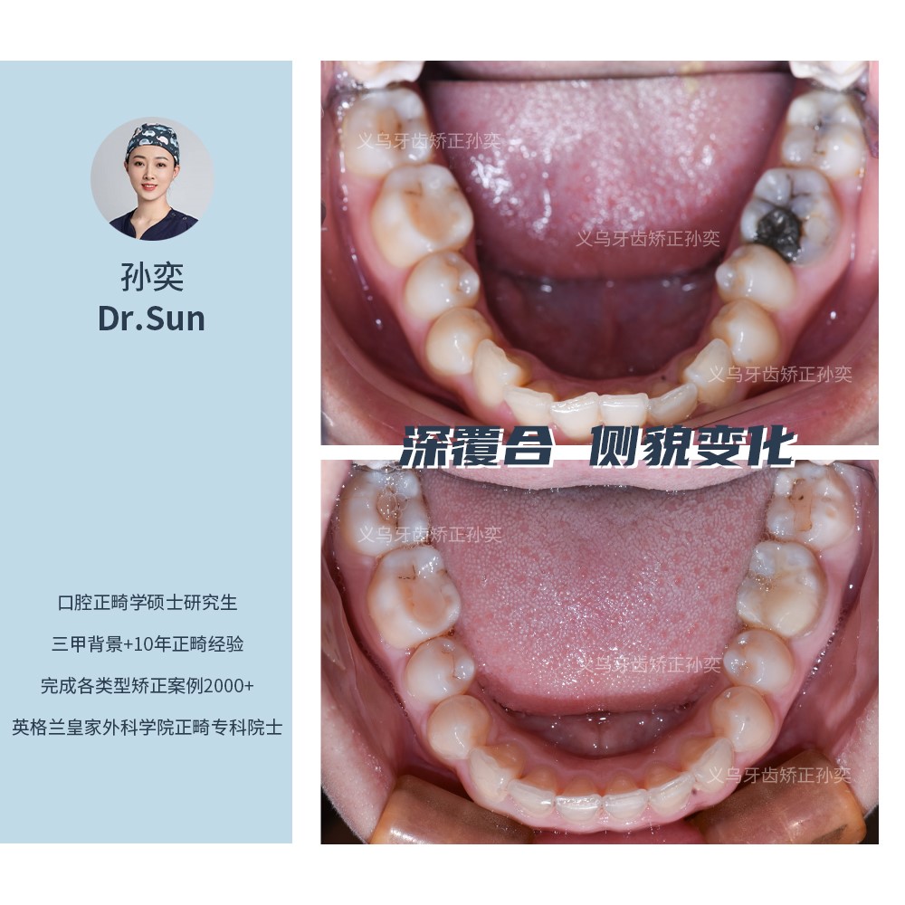 义乌傅氏口腔深覆合侧貌变化矫正案例分享！