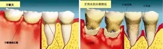 牙周炎的十大罪状！—义乌傅氏口腔