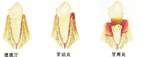 牙周炎的十大罪状！—义乌傅氏口腔
