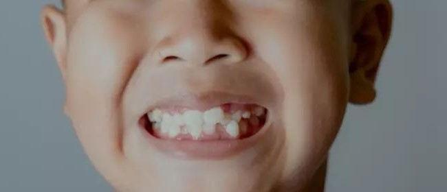 儿童牙齿矫正不容错过的黄金时机！—义乌傅氏口腔