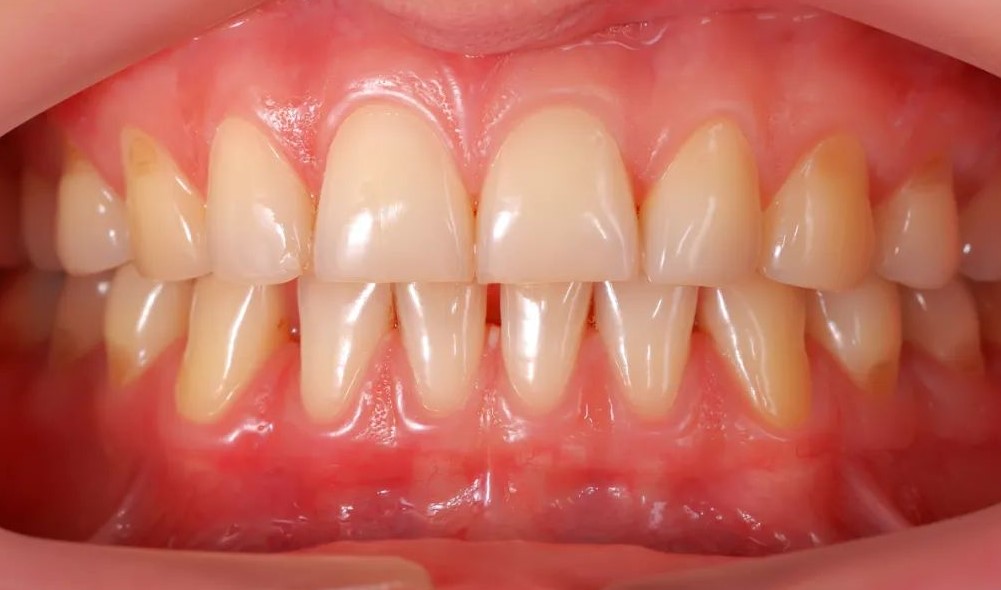 牙痛是上火多少人被骗？