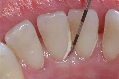 你会刷牙吗？巴氏刷牙法学起来！—义乌傅氏口腔