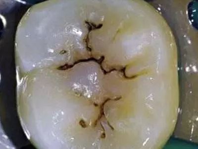 刷牙都刷不掉的牙齿黑线! 刷牙都刷不掉的牙齿黑线!