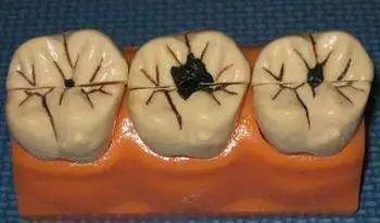 刷牙都刷不掉的牙齿黑线! 刷牙都刷不掉的牙齿黑线!