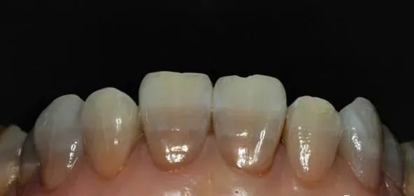 什么是四环素牙,四环素牙如何治疗? 什么是四环素牙,四环素牙如何治疗?