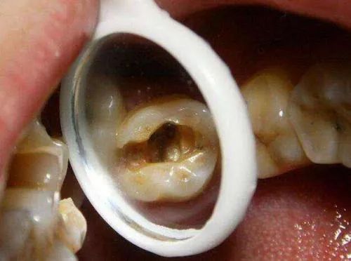 治疗牙齿深龋的注意事项! 治疗牙齿深龋的注意事项!