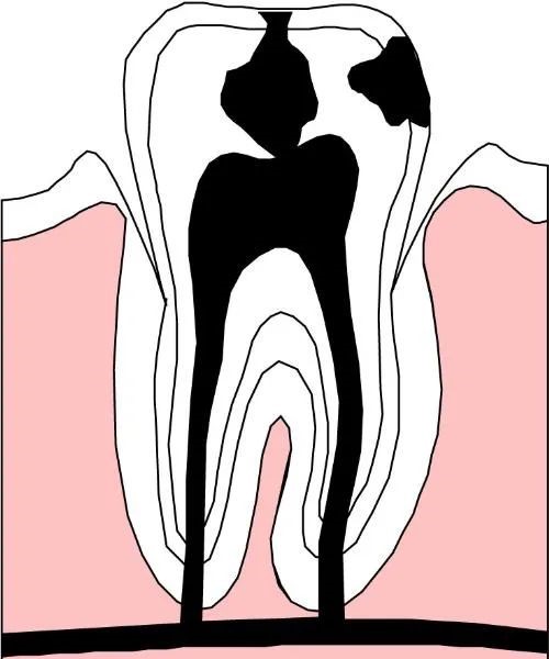 治疗牙齿深龋的注意事项! 治疗牙齿深龋的注意事项!