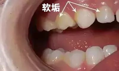 小孩牙齿上的黑色素能去掉吗？