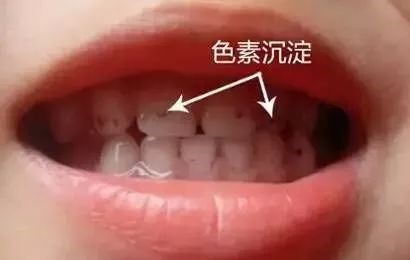 小孩牙齿上的黑色素能去掉吗？